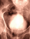 Medical and Surgical Management of Bladder Outlet Obstruction