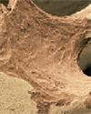 Managing Bone Loss Associated with Androgen Deprivation Therapy