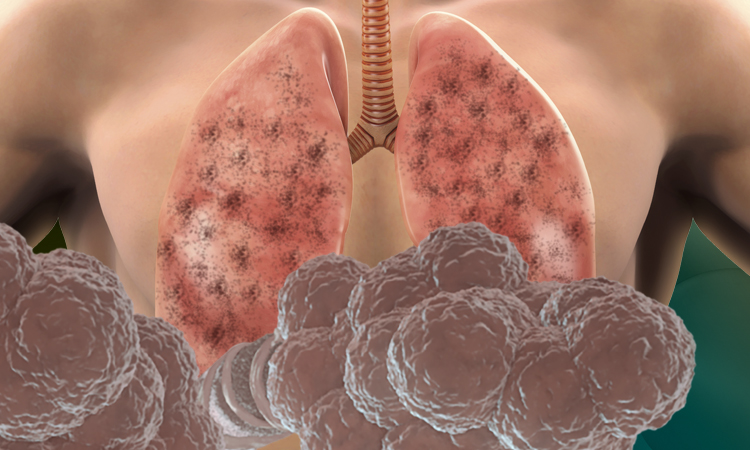 Lung Diseases Treated With Viagra