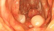 Precancerous Lesions in the GI Tract: Lifting and Resection Techniques Precancerous Lesions in the GI Tract: Lifting and Resection Techniques