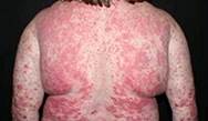 Case Study Challenge: A 49-Year-Old Woman With Psoriasis and Hodgkin's Disease Case Study Challenge: A 49-Year-Old Woman With Psoriasis and Hodgkin's Disease