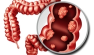 Exploring Current Metastatic Colorectal Cancer (mCRC) Treatment Options Exploring Current Metastatic Colorectal Cancer (mCRC) Treatment Options