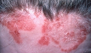 Case Study Challenge: A 35-Year-Old with Psoriasis, Obesity and Pregnancy Case Study Challenge: A 35-Year-Old with Psoriasis, Obesity and Pregnancy