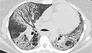 Emerging Strategies in the Diagnosis and Treatment of Systemic Sclerosis-Associated Interstitial Lung Disease (SSc-ILD) Emerging Strategies in the Diagnosis and Treatment of Systemic Sclerosis-Associated Interstitial Lung Disease (SSc-ILD)