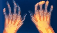 A Team Approach to Improving Outcomes in Rheumatoid Arthritis: Clinicians, Patients, and Digital Health Coaches A Team Approach to Improving Outcomes in Rheumatoid Arthritis: Clinicians, Patients, and Digital Health Coaches