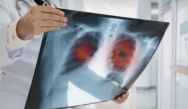MediBrief: Fast-tracking Emerging Non-Small Cell Lung Cancer Immunotherapy Evidence into Practice MediBrief: Fast-tracking Emerging Non-Small Cell Lung Cancer Immunotherapy Evidence into Practice