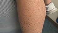 Dermatology Clinics and Challenges: June 2018 Dermatology Clinics and Challenges: June 2018