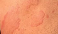 Clinical Reflections<sup>®</sup>: Reflecting on Errors and Missed Opportunities in Chronic Urticaria