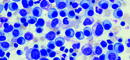 lymfoblastisk leukemi